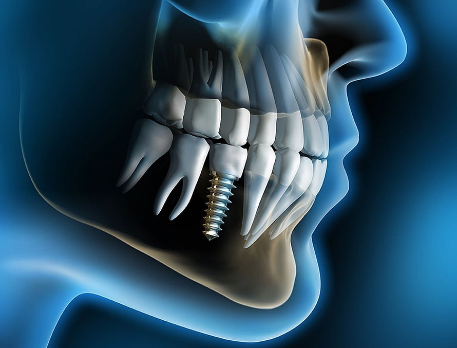 3D Medical Illustration of Dental Implant in Human Jaw and Teeth, Dental Implants And Prosthetics, Dentist HD wallpaper